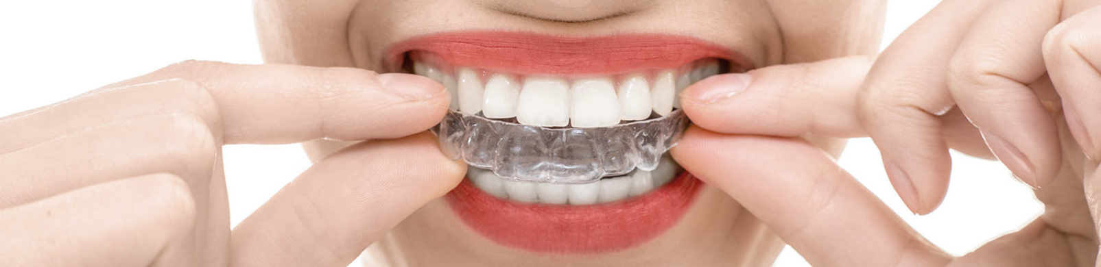 invisalign finchley north london - apex dental